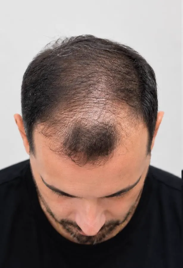 Cuero cabelludo con clareos y entradas suaves antes de la micropigmentación de efecto densidad