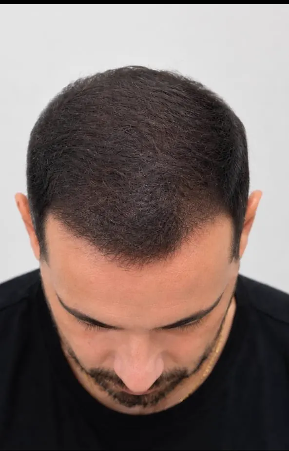 El mismo cuero cabelludo después de la micropigmentación de efecto densidad, con la zona clara cubierta