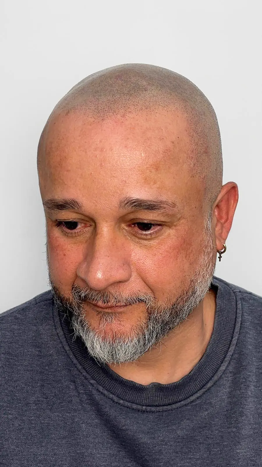 Cabeza rapada con micropigmentación de efecto rapado que simula folículos punto a punto